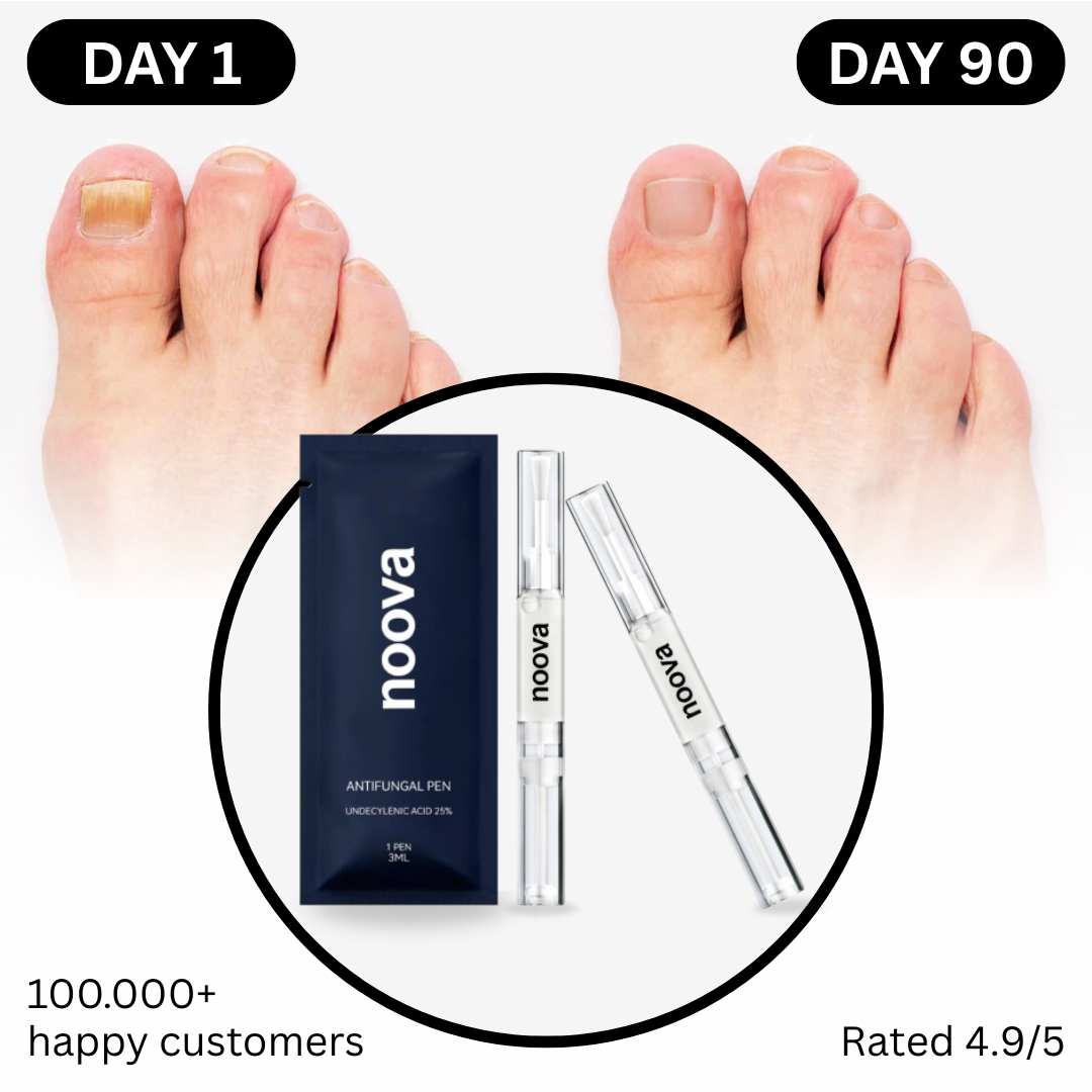 Antifungal Nail Pen (FREE Today)